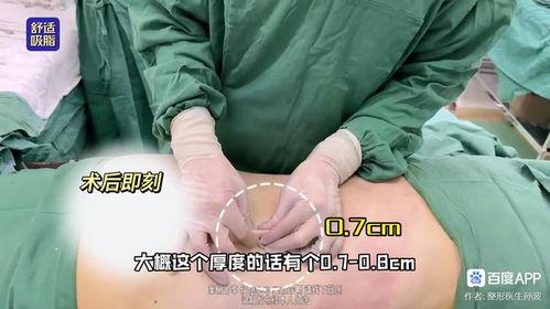 爆料桂哥抽脂视频教程,轻松掌握塑形技巧